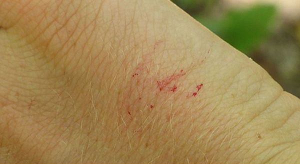 a photo of a snake bite on human skin